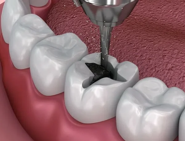 types of amalgam